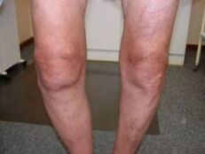 Symptômes d'arthrose de l'articulation du genou