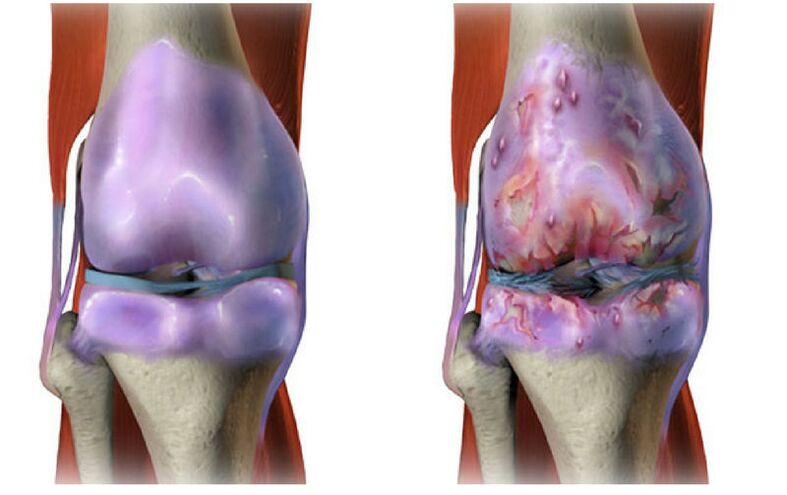 cartilage sain et destruction de l'articulation du genou avec arthrose