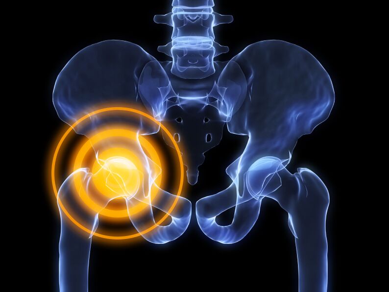 arthrose de l'articulation de la hanche